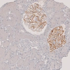 Immunohistochemical staining of human kidney (idiopathic membranous nephropathy) shows strong membranous positivity in cells in glomeruli.