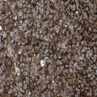 Immunohistochemical staining of human glioma shows strong positivity in tumor cells.