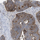 Immunohistochemical staining of human colorectal cancer shows strong membranous positivity in tumor cells.