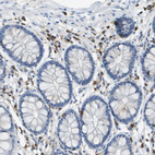 Immunohistochemical staining of human colon shows strong cytoplasmic positivity in lymphoid cells.