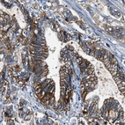 Immunohistochemical staining of human stomach cancer shows moderate to strong membranous positivity in tumor cells.
