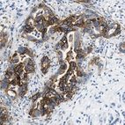 Immunohistochemical staining of human pancreatic cancer shows moderate membranous positivity in tumor cells.