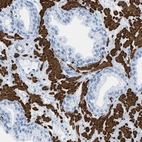 Immunohistochemical staining of human prostate shows strong cytoplasmic positivity in smooth muscle cells.