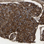 Immunohistochemical staining of human prostate cancer shows moderate cytoplasmic positivity.