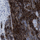 Immunohistochemical staining of human colorectal cancer shows strong membranous positivity in tumor cells.