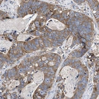 Immunohistochemical staining of human stomach cancer shows moderate cytoplasmic positivity in tumor cells.