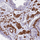 Immunohistochemical staining of human prostate shows strong cytoplasmic positivity in smooth muscle cells.