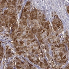 Immunohistochemical staining of human breast cancer shows moderate to strong cytoplasmic positivity in tumor cells.