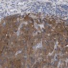 Immunohistochemical staining of human malignant melanoma shows moderate cytoplasmic positivity in tumor cells.
