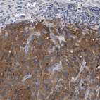 Immunohistochemical staining of human malignant melanoma shows moderate cytoplasmic positivity in tumor cells.