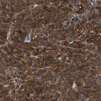 Immunohistochemical staining of human malignant melanoma shows strong cytoplasmic positivity in tumor cells.