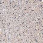 Immunohistochemical staining of human astrocytoma shows moderate nuclear positivity in a subset of tumor cells.