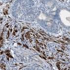 Immunohistochemical staining of human prostate shows strong cytoplasmic positivity in smooth muscle cells.