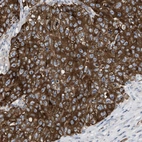 Immunohistochemical staining of human testis cancer shows strong cytoplasmic positivity in tumor cells.