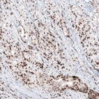 Immunohistochemical staining of human stomach cancer shows moderate to strong nuclear positivity in tumor cells.