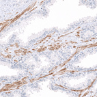 Immunohistochemical staining of human prostate shows positivity in smooth muscle cells.