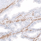 Immunohistochemical staining of human prostate shows positivity in smooth muscle cells.