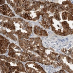 Immunohistochemical staining of human lung cancer, adenocarcinoma shows strong cytoplasmic positivity in tumor cells.