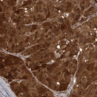 Immunohistochemical staining of human malignant melanoma shows strong cytoplasmic positivity in tumor cells.