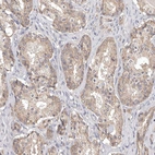 Immunohistochemical staining of human prostate cancer shows moderate cytoplasmic positivity in tumor cells.