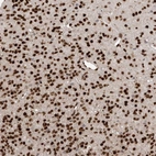 Immunohistochemical staining of human glioma shows strong nuclear positivity in tumor cells.