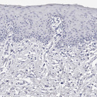 Immunohistochemical staining of human skin shows no positivity in squamous epithelial cells as expected.