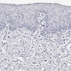Immunohistochemical staining of human skin shows no positivity in squamous epithelial cells as expected.