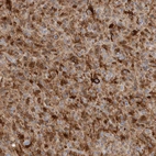 Immunohistochemical staining of human glioma shows strong cytoplasmic positivity in tumor cells.