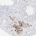 Immunohistochemical staining of human testis shows strong granular cytoplasmic positivity in Leydig cells.