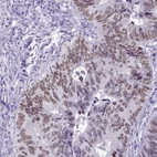 Immunohistochemical staining of human colorectal cancer shows moderate nuclear positivity in tumor cells.