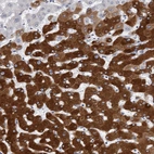 Immunohistochemical staining of human liver shows strong cytoplasmic positivity in tumor cells.