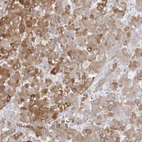 Immunohistochemical staining of human liver cancer, hepatocellular carcinoma shows moderate cytoplasmic positivity in tumor cells.
