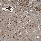 Immunohistochemical staining of human Liver cancer shows strong extracellular space and cytoplasmic positivity in tumor cells.