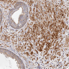 Immunohistochemical staining of human prostate shows moderate to strong cytoplasmic/membranous positivity in smooth muscle cells.