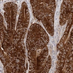 Immunohistochemical staining of human colorectal cancer shows strong positivity in tumor cells.