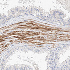 Immunohistochemical staining of human prostate shows strong cytoplasmic positivity in smooth muscle cells.