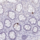 Immunohistochemical staining of human colon shows strong cytoplasmic positivity in enteroendocrine cells.