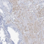 Immunohistochemical staining of human prostate shows weak cytoplasmic positivity in smooth muscle cells.