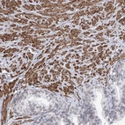 Immunohistochemical staining of human prostate shows strong cytoplasmic positivity in smooth muscle cells.