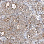 Immunohistochemical staining of human breast cancer shows moderate membranous positivity in tumor cells.
