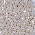 Immunohistochemical staining of human prostate cancer shows moderate membranous positivity in tumor cells.