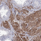 Immunohistochemical staining of human prostate shows strong cytoplasmic positivity in smooth muscle cells.