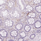 Immunohistochemical staining of human colon shows moderate cytoplasmic positivity in enteroendocrine cells.