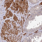 Immunohistochemical staining of human Prostate shows strong granular cytoplasmic positivity in smooth muscle cells.