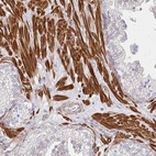 Immunohistochemical staining of human prostate shows strong cytoplasmic positivity in smooth muscle cells.