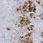Immunohistochemical staining of human breast cancer shows moderate to strong cytoplasmic positivity in tumor cells.