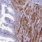 Immunohistochemical staining of human prostate shows strong cytoplasmic positivity in smooth muscle cells.