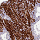 Immunohistochemical staining of human prostate shows strong cytoplasmic positivity in smooth muscle cells.