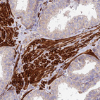 Immunohistochemical staining of human prostate shows strong cytoplasmic positivity in smooth muscle cells.