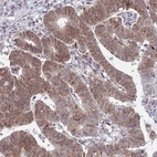 Immunohistochemical staining of human colorectal cancer shows moderate nuclear positivity in tumor cells.